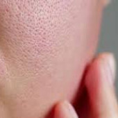 Enlarged Pores (11)