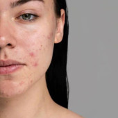 For Acne-Prone Skin (1)